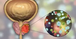 12 sinais de câncer de próstata em estágio avançado