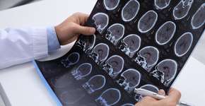 Estudo indica que Alzheimer tem início 20 anos antes dos sintomas iniciais