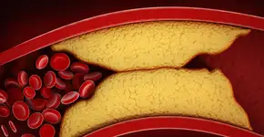 Novo estudo faz alerta: colesterol alto pode estar ligado à demência