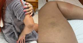 Modelo brasileira relata ter sido agredida por noivo na Espanha