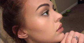 Após espremer ‘espinha dolorosa’, jovem descobre infecção grave