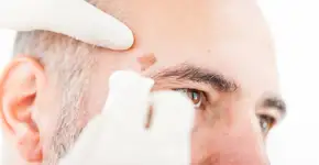 Câncer de pele: sintomas, como identificar e qual o tratamento