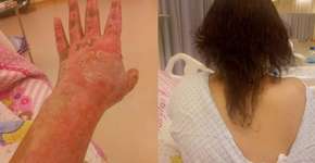 Homem é preso após atear fogo em enteada em Nova Iguaçu