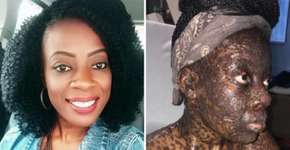 Mulher fica irreconhecível após reação a remédio para ouvido