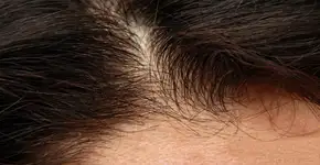 Covid-19 afeta cabelo de homens e mulheres, apontam médicos