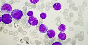 Remédio experimental cura 18 pessoas de leucemia