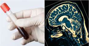 Este valor no exames de sangue pode indicar Alzheimer no início