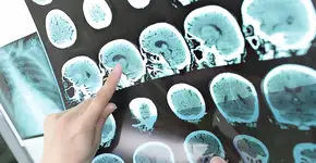 Estudo de Harvard mostra que estilo de vida está relacionado ao risco de AVC