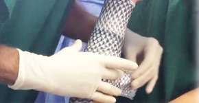 Cientistas brasileiros testam pele de tilápia contra queimaduras