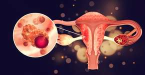 O câncer que atinge 15 em cada 100 pessoas no Brasil e como prevenir