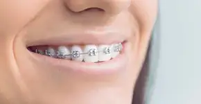 Fio de aparelho é encontrado no intestino de mulher após 10 anos