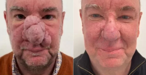 Homem reconstrói o nariz após rinofima; entenda a doença