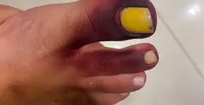 Jovem fica com os dedos do pé roxos após contato com gongolo