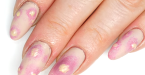 Espinhas inflamadas inspiram decoração de unhas que soltam pus