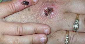 Foto: (reprodução/CDC)