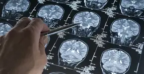 8 sintomas pouco conhecidos do Parkinson que podem te surpreender