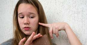 É verdade que chocolate dá espinha? Veja o que diz a ciência