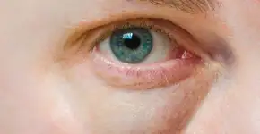 Veja como não ter bolsas nos olhos