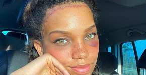 Modelo gasta R$ 39 mil para reduzir a testa; veja como é feita a cirurgia