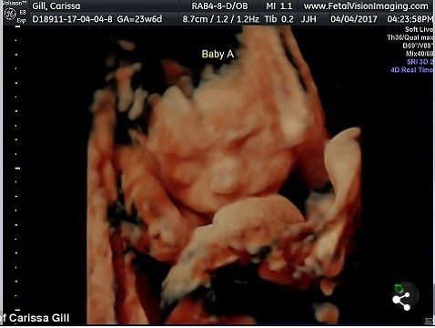 As gêmeas Isabella e Callie em registro da 25º semana de gestação