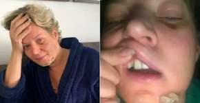 Com fraturas no rosto, Joice Hasselmann diz ter sofrido atentado