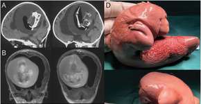 Foto: (reprodução/NEUROLOGY)