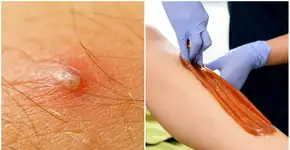 Saiba como acabar com pelos encravados e 7 truques para evitá-los