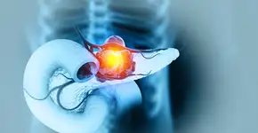 O que causa câncer de pâncreas? Os fatores de risco modificáveis e não modificáveis