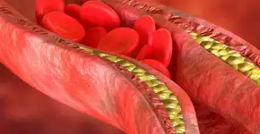 Aprenda a controlar o colesterol ruim