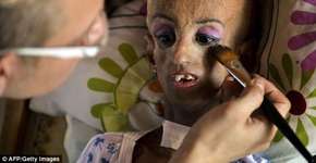 ‘Acho que sou bonita’: garota com doença rara supera expectativa de vida e faz 15 anos de idade