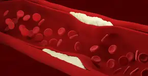 Sinais curiosos de colesterol alto que aparecem nos olhos e na pele