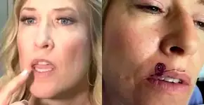 Mulher descobre que espinha acima do lábio era um câncer