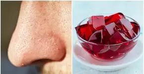Truque promete remover cravos do rosto usando apenas gelatina