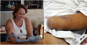 Após ter as mãos decepadas pelo ex, mulher precisa de próteses