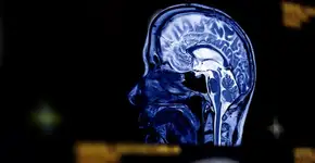 Estes são os sintomas de aneurisma cerebral