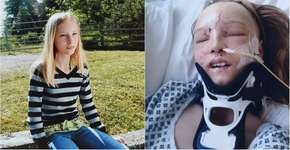 Garota que teve rosto desfigurado por acidente passa por cirurgia de reconstrução facial