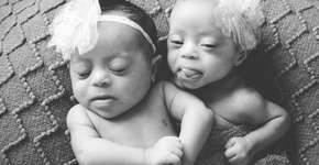 Fotógrafa registra primeiros dias de vida de gêmeas com Síndrome de Down