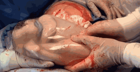 Gêmeos nascem ‘empelicados’ dentro de bolsa amniótica em SP