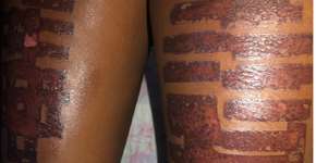 Fotodepilação provoca queimaduras de 2º grau em modelo