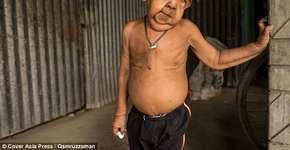 Benjamin Button real: garoto de 4 anos parece um idoso