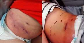 Mãe faz alerta após dar ibuprofeno ao filho com catapora