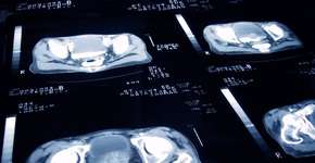 Estes são os sinais de alerta de câncer de próstata