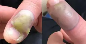 Escocês é operado às pressas após infecção por roer as unhas