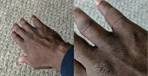 Homem se emociona ao descobrir curativo da cor de pele negra