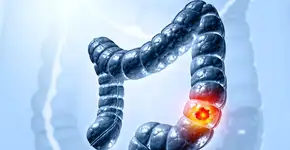 Descubra o alimento que estudos mostram reduzir o risco de câncer de intestino