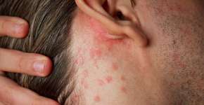 Surto de lesões cutâneas é investigado no Recife após 79 casos