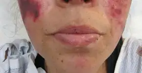 Fotos revelam como a cocaína pode apodrecer a pele