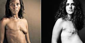 Câncer de mama: mulheres mostram o corpo em ensaio fotográfico