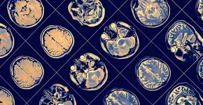 Estudo revela motivos que levam pessoas a terem Alzheimer