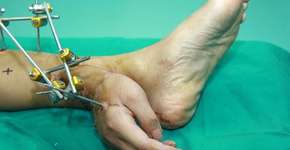 Após acidente, homem tem mão implantada ao tornozelo